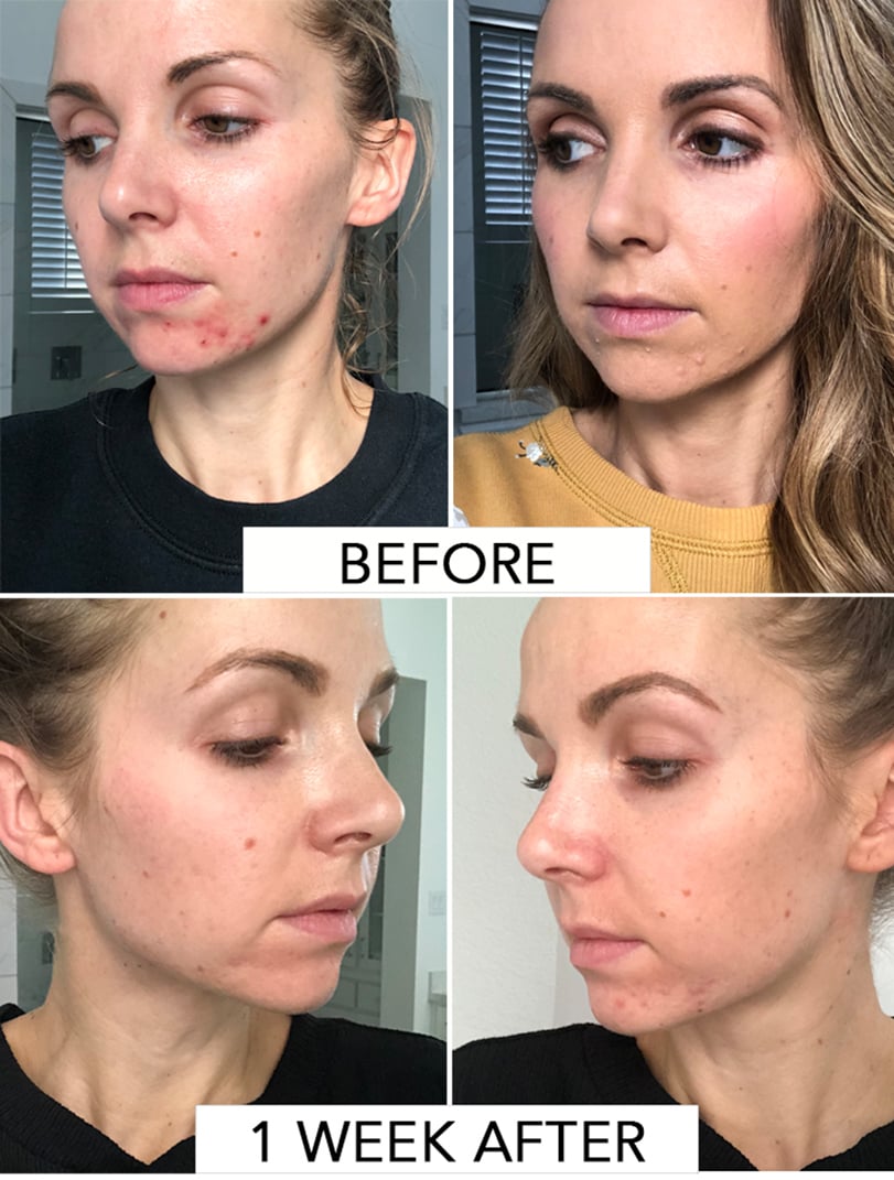 acne before and after